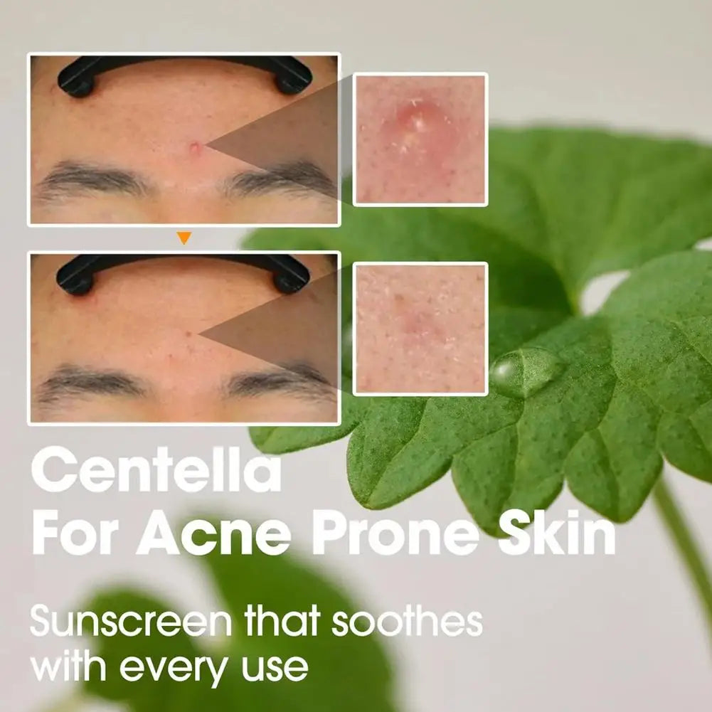 Korean SOME BY MI AHA BHA PHA Tea Tree Triac Acid Essence Face Cream Set for Deep Cleaning of Acne-Sensitive Skin