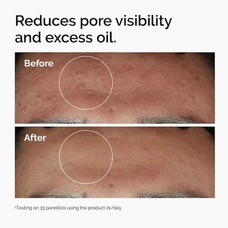 Korean Niacinamide 10% + Zinc 1% Serum 30ml Multi Effect Improve Texture Reduce Excess Oil Strengthen Skin Moisture Barrier